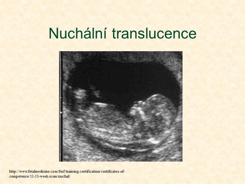 Nuchální translucence http://www.fetalmedicine.com/fmf/training-certification/certificates-of-competence/11-13-week-scan/nuchal/